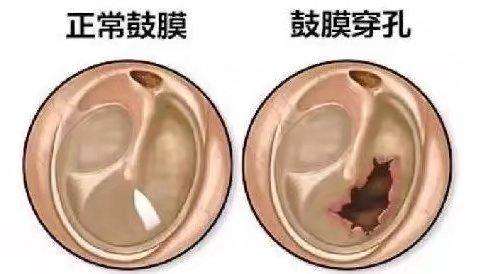 鼓膜穿孔的症状