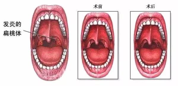 重庆扁桃体炎