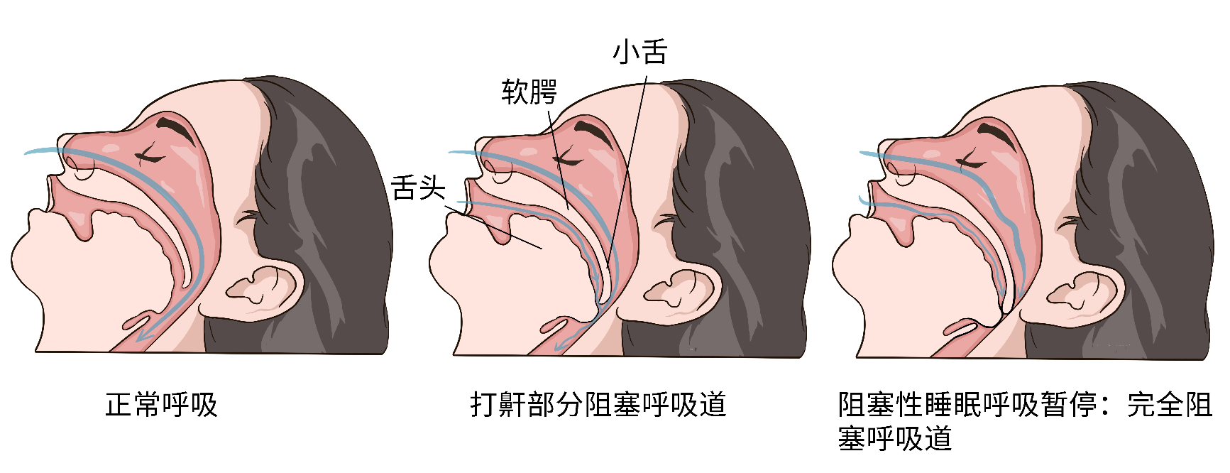 打鼾