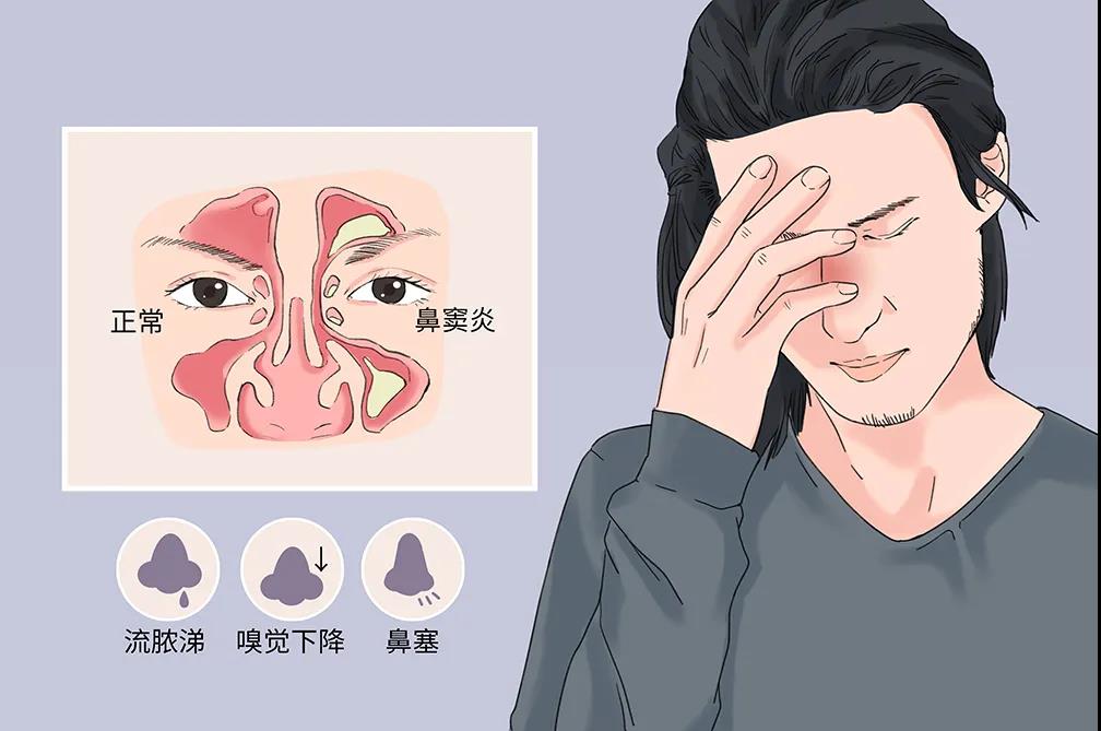 重庆鼻窦炎医院